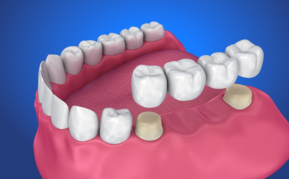 your-guide-to-dental-bridges